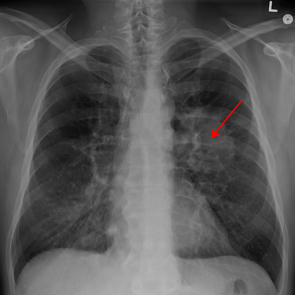 Lung cancer xray